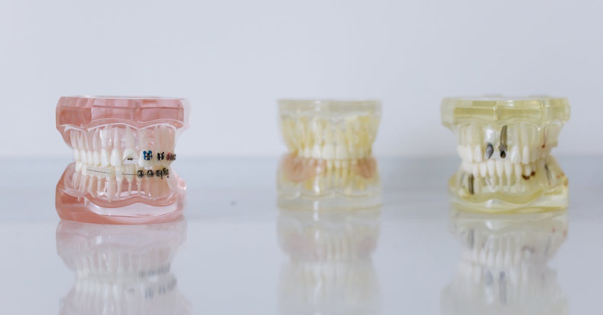 Discounts and Promotions on Tooth Implants in Turkey  