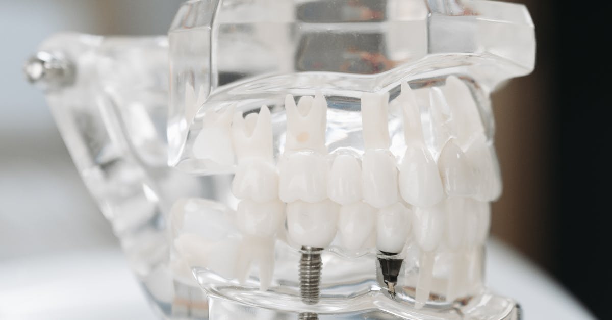 Improved Speech Clarity with Tooth Implants  