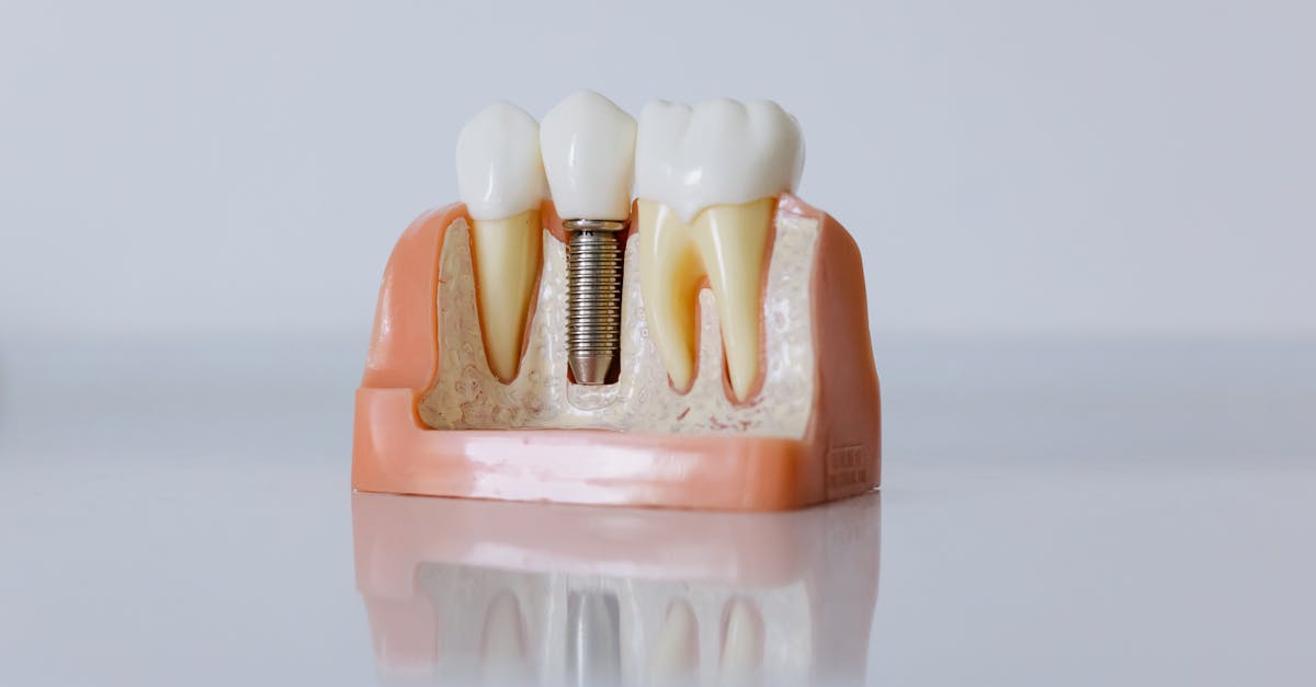 Tooth Implants vs. Dentures: Benefits in Turkey  